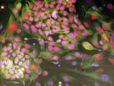 Bulgaria: Unique Stem Cell Transplantation Carried Out in Bulgaria