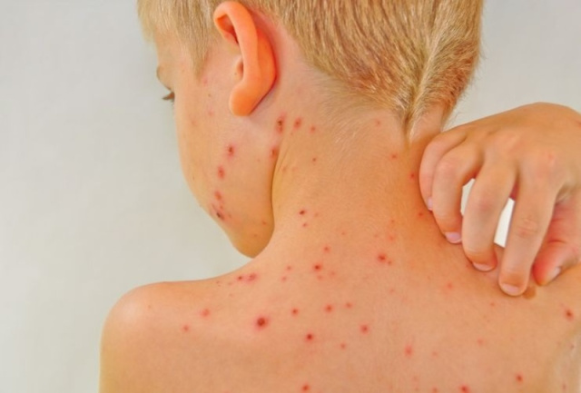 Bulgaria: Bulgarian Doctor: The Cases of Chickenpox have Increased more than 4 Times