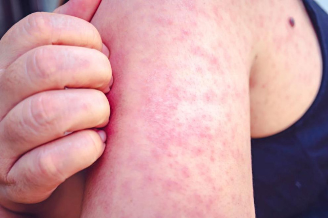 Bulgaria: First Measles Case Reported in Bulgaria!