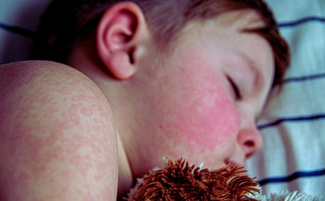 Bulgaria: Measles Outbreak in Bulgaria Surpasses 100 Cases, Majority are Children